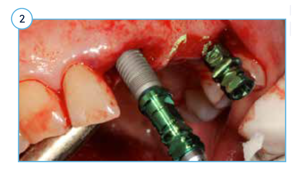 Case Study TSV - 2 TSVT Implants (4.1 mm x 16 mm) with attached fixture mounts threaded into the prepared extraction sockets.