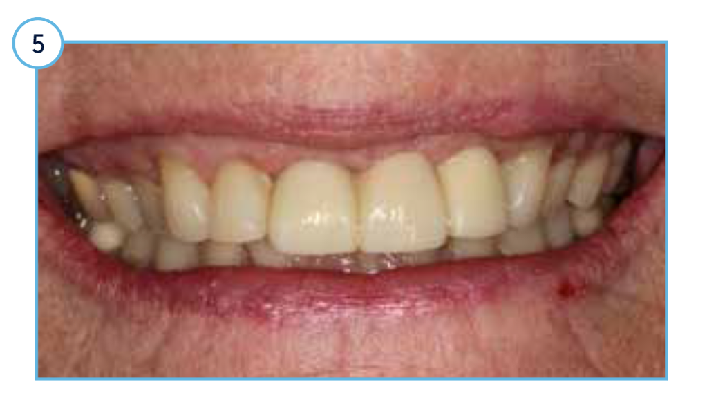 Case Study TSV - 5 Clinical view of the aesthetic outcome one-year post restoration.