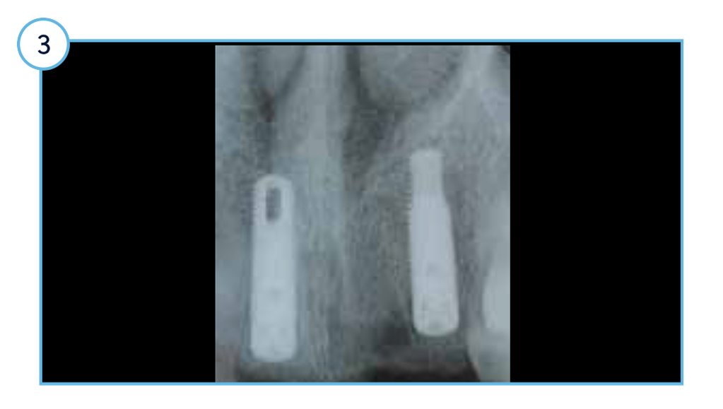 Case Study TSV - 3 surgical cover screws attached.