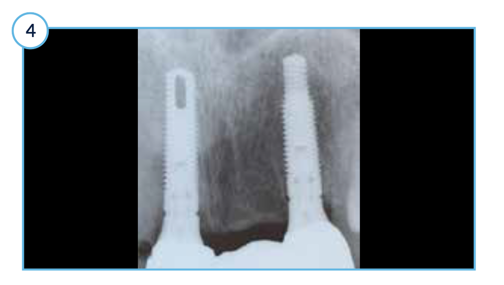 Case Study TSV - 4 One-year post-placement radiograph with stable marginal bone levels around TSVT implants.