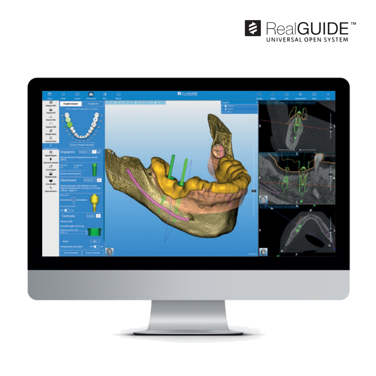 RealGUIDE software screen offering everything you might need for precise planning, designing, and predictable placement of dental implants.