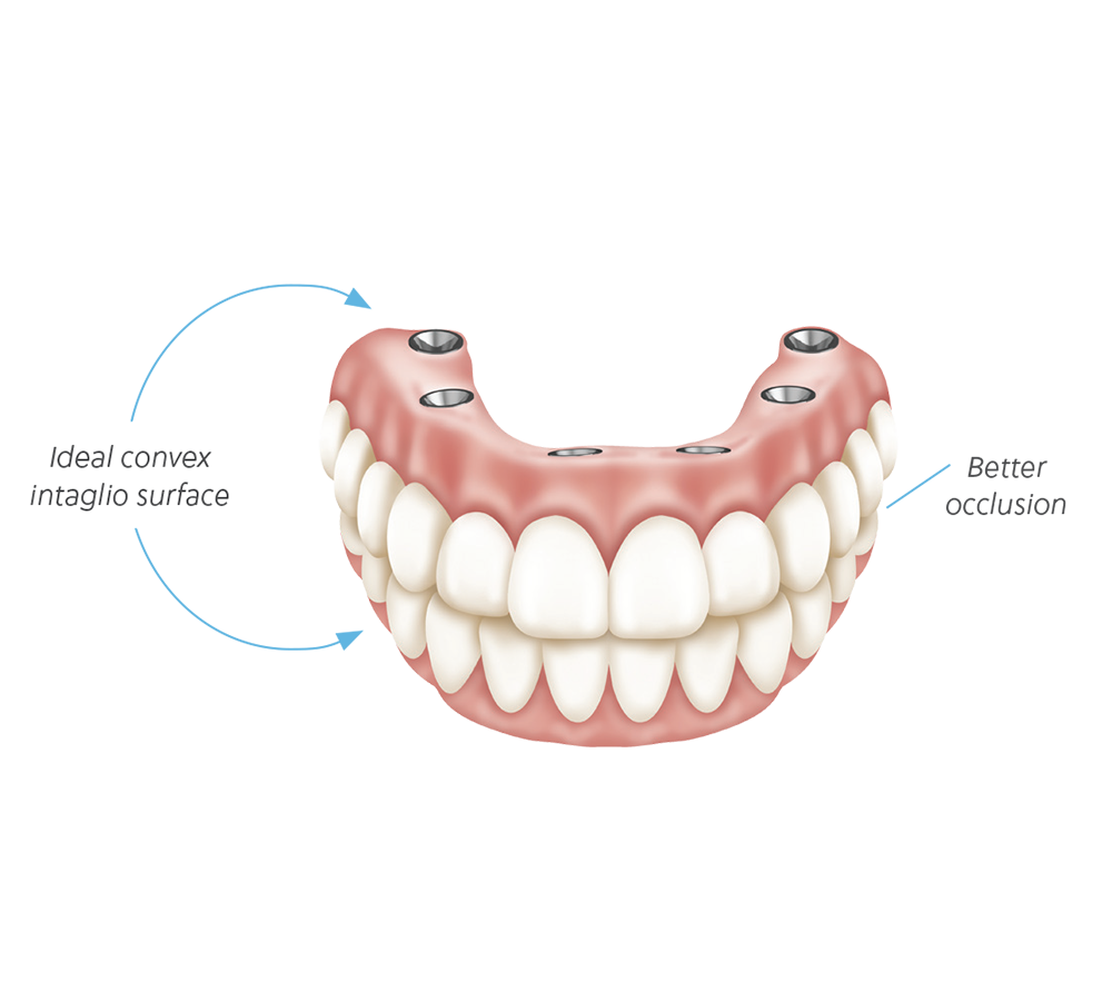 Create better contours without the need to unnecessarily bulk the prosthesis. Improve occlusion by utilizing a fully occluded pickup technique, reducing the need for major occlusal adjustments.