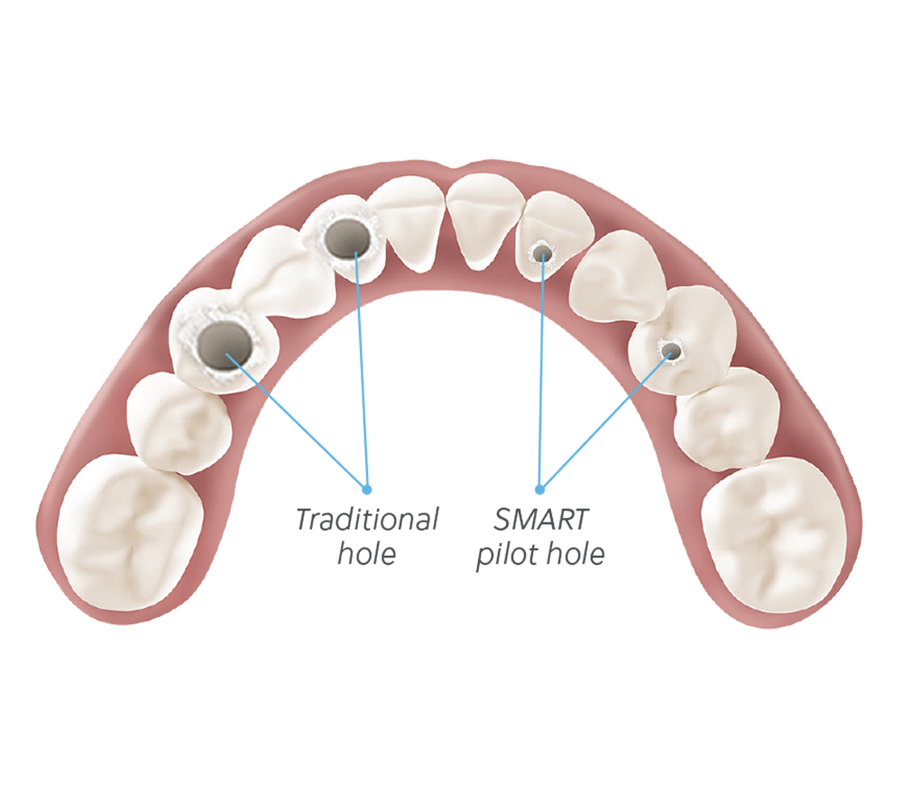 Engaging in implant, not for use in single-unit restorations